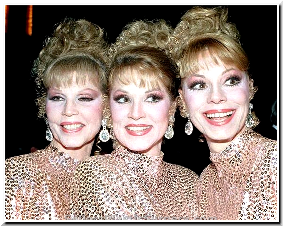 Did Mcguire Sisters Have Plastic Surgery?
